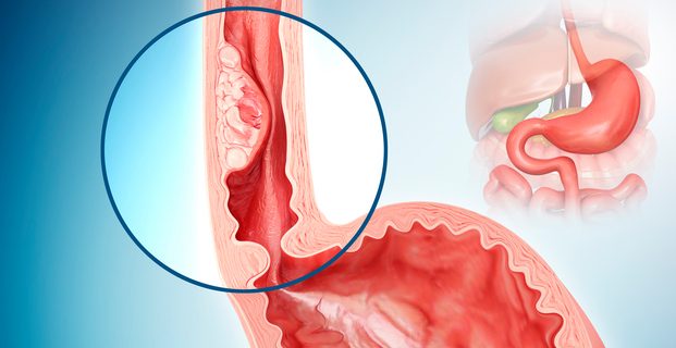 Oesophageal cancer, illustration