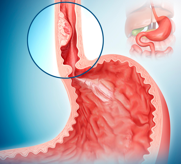 Oesophageal cancer, illustration