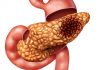 MED12 Found to Be Key Player in Basal-Like Pancreatic Cancer