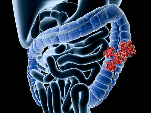 Image of gut and intestines showing colorectal cancer highlighted in red.
