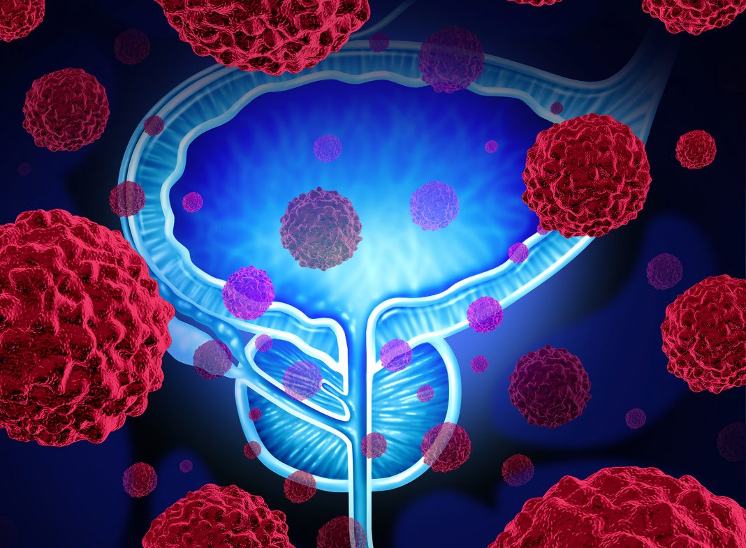 advanced-prostate-cancer-progression-aided-by-gut-microbiota-inside