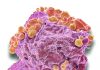 Mantle Cell Lymphoma Patients May Not Need Stem Cell Transplant