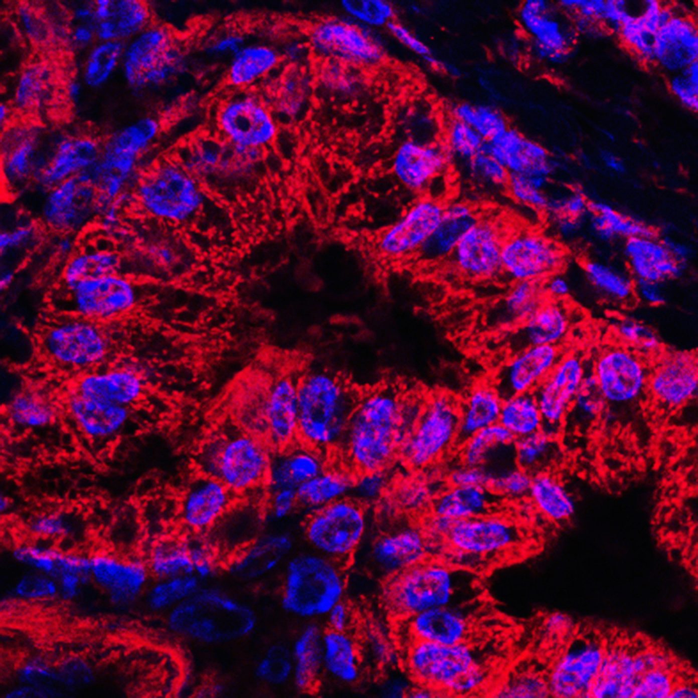 new-insights-to-pancreatic-cancer-treatment-resistance-uncovered