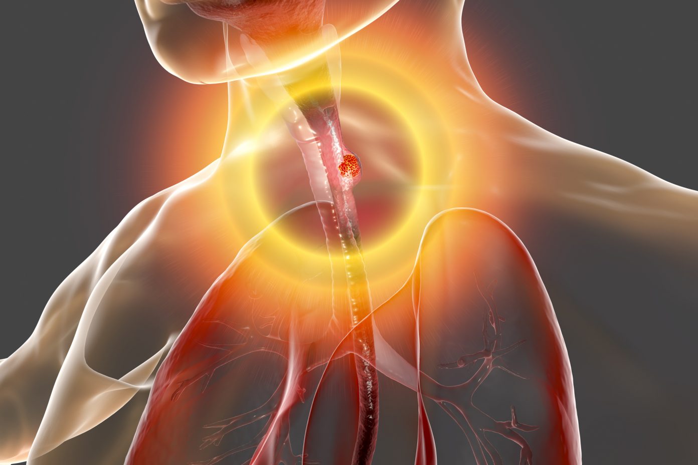 Study: Barrett’s Esophagus Always Precedes Esophageal Cancer | Inside