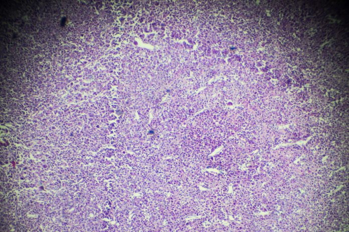 Osteosarcoma biopsy under light microscopy