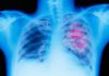 Deep Learning Program Predicts Lung Cancer Return