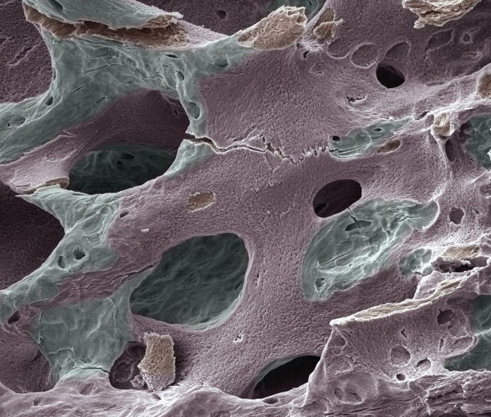 Scanning electron micrograph (SEM) of human bone, osteoporosis