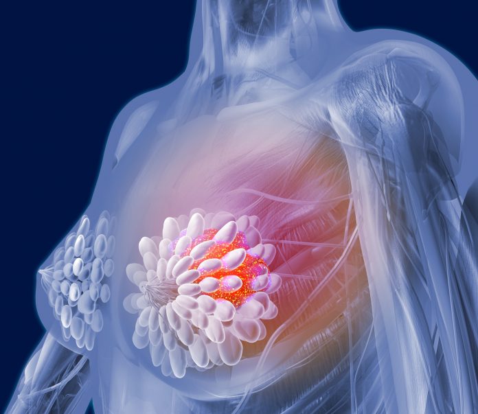 Genetic Test Can Identify Triple Negative Breast Cancer Treatment
