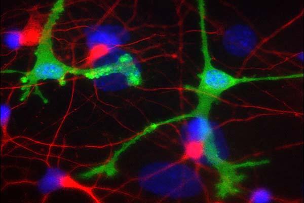 Parkinson’s, Alzheimer’s Experimental Antibody Treatments May Cause Brain Inflammation