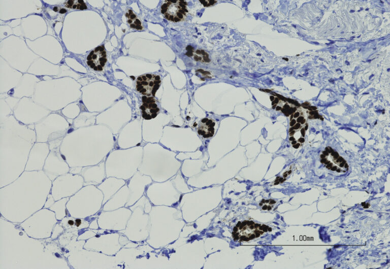 Low grade ductal carcinoma with positive estrogen receptor