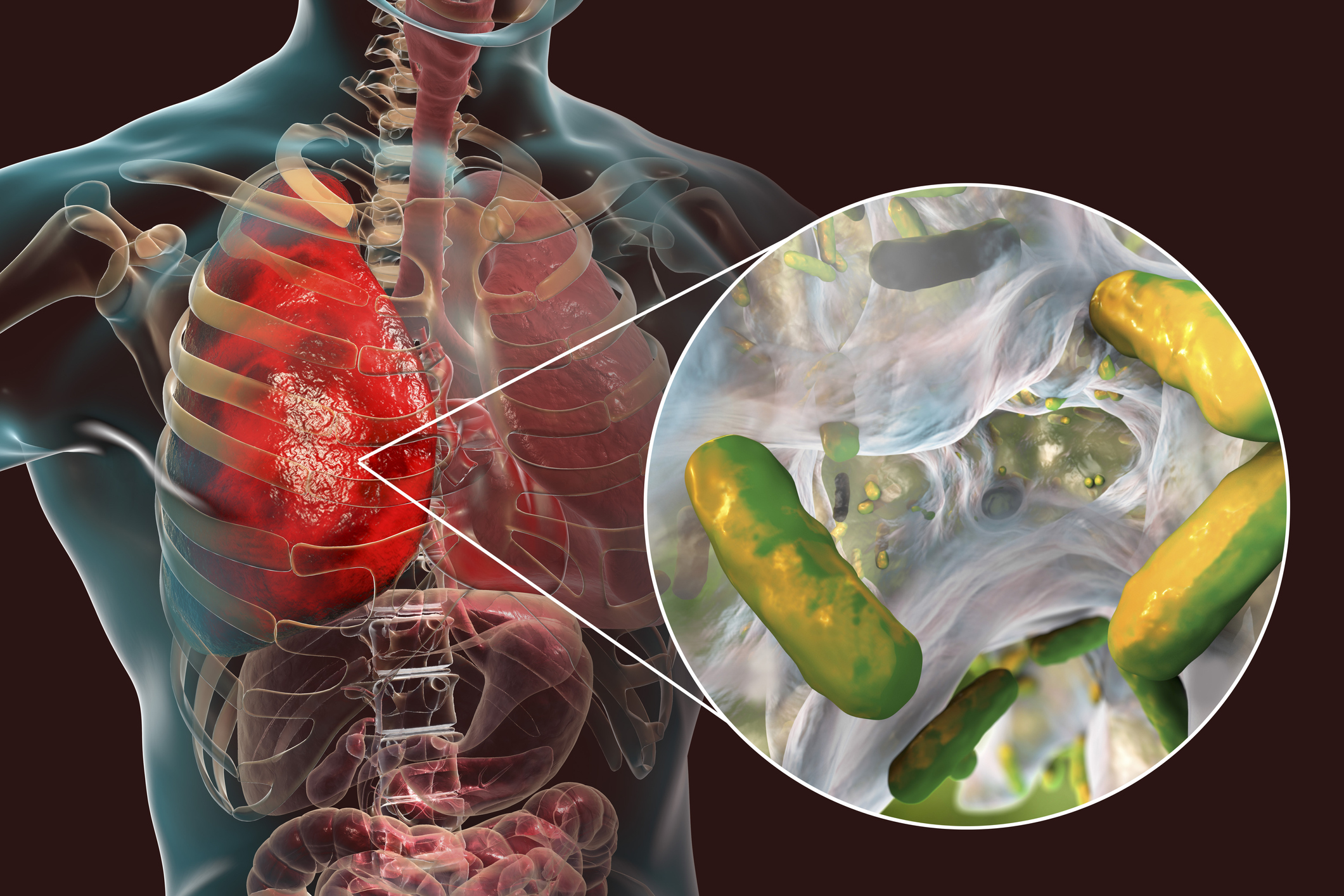 Lung Model On A Chip Better Identifies CF Related Bacterial Infections 