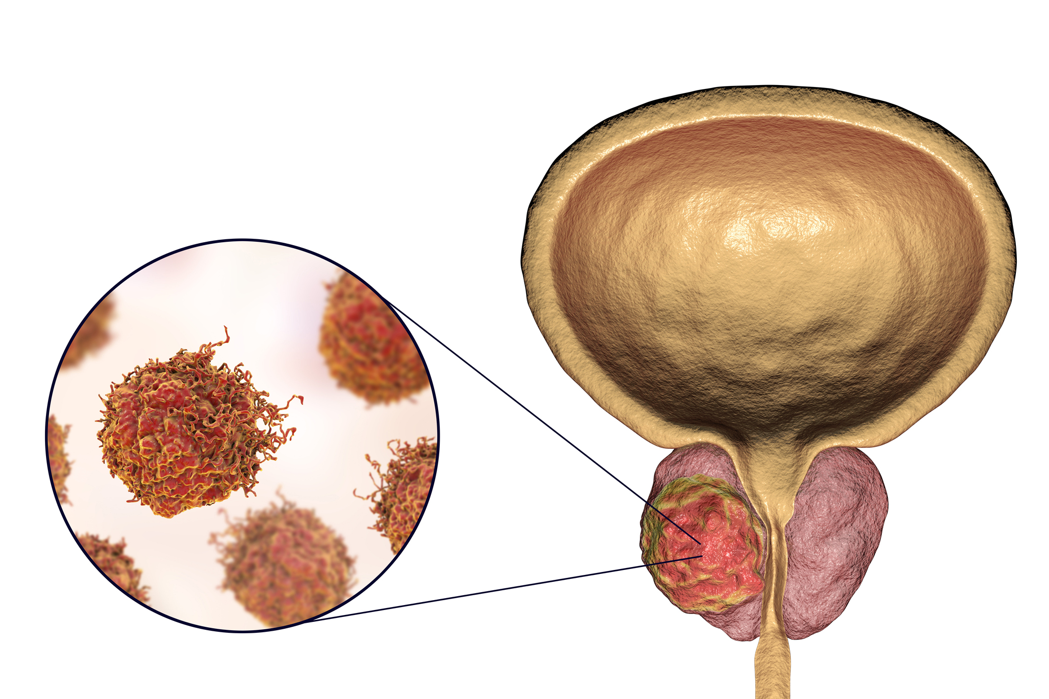 Optimal High Risk Prostate Cancer ADT Duration May Be Radiotherapy 