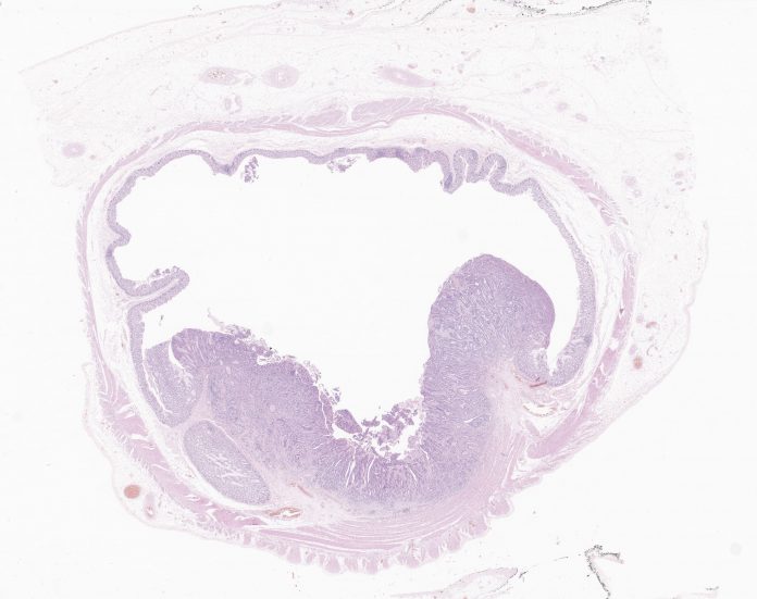 colorectal carcinoma