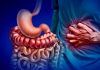 Genetic Variant Could Predict Severe Ulcerative Colitis