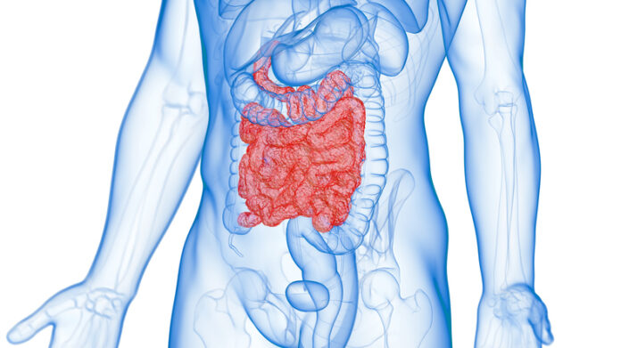 Transparent image of a human torso showing inflamed small intestine, as seen in Crohn's disease patients