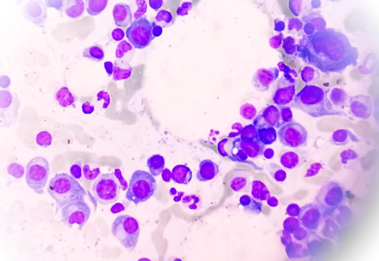 Microscopic view of bone marrow slide showing Multiple myeloma, also known as myeloma, is a type of bone marrow cancer.