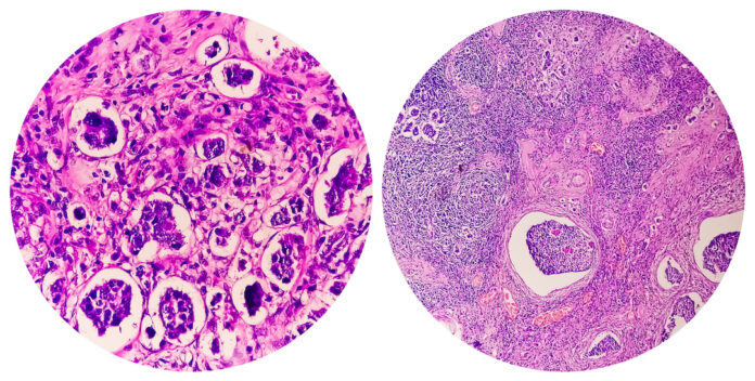 College of two photomicrograph showing Invasive ductal carcinoma (IDC) grade-II, most common form of breast cancer. Lymphovascular invasion: Present