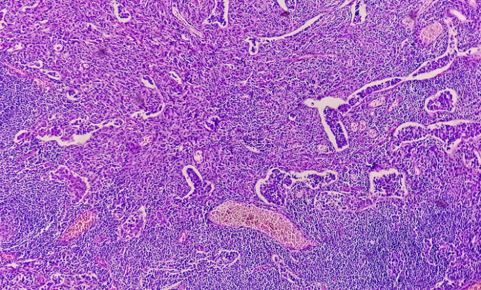 Gastric Adenocarcinoma