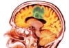 Rapid Liquid Biopsy Test for Glioblastoma Developed by Notre Dame Team