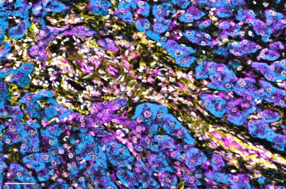 Low NBR1 levels in hepatic stellate cells