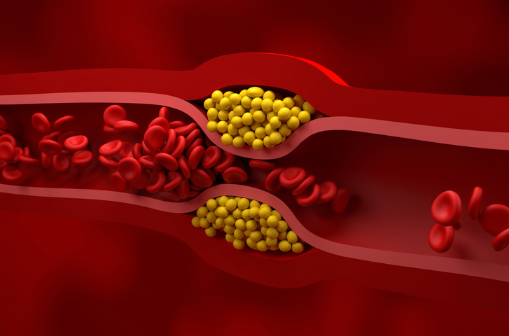 Narrowed artery, illustration