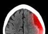 Combination Treatment Reduces Subdural Hematoma Recurrence