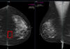 Women Pay for AI-Enhanced Mammography