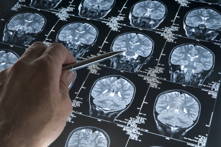 MRI Brain Scan of head and skull with hand pointing showing amyloid in the brain, which is a risk for Alzheimer's disease